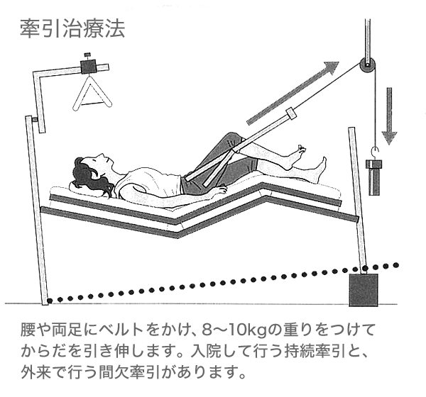 牽引治療